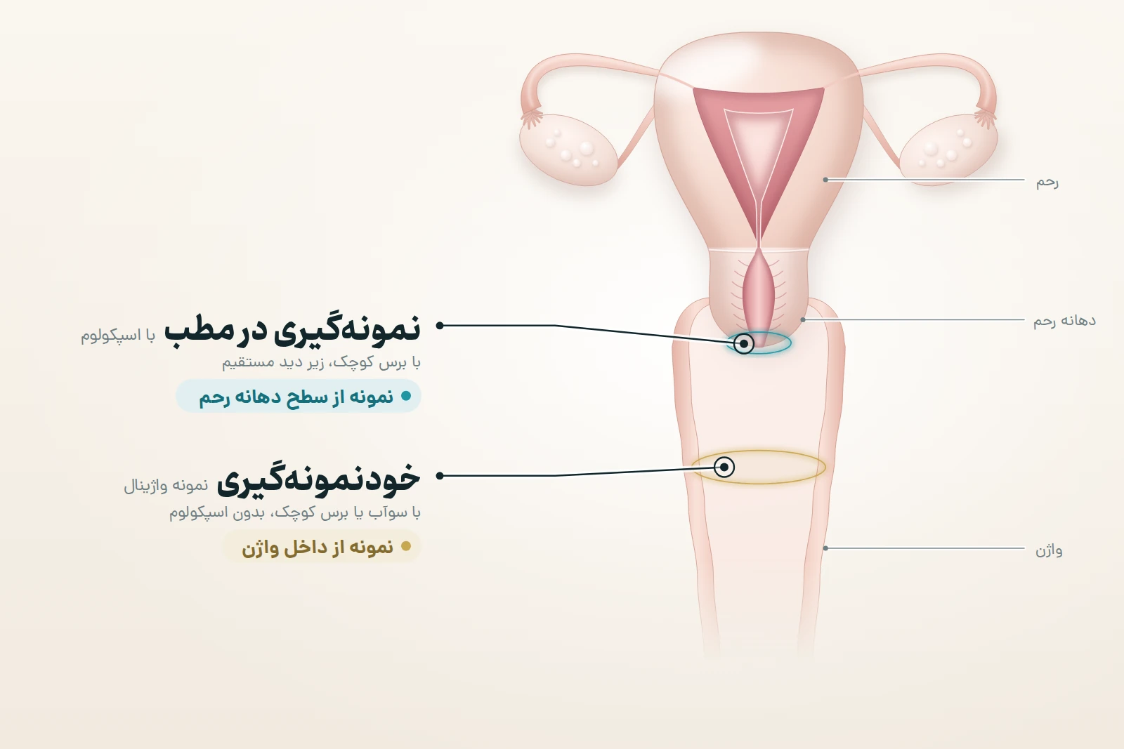 نمای ساده روبهرو از رحم، دهانه رحم و واژن با دو محل نمونه: در نمونهگیری در مطب، پزشک یا ماما با اسپکولوم و برس کوچک از سطح دهانه رحم نمونه میگیرد؛ در خودنمونهگیری، فرد با یک سوآب یا برس کوچک از داخل واژن نمونه میگیرد و اسپکولوم لازم نیست. تفاوت اصلی در محل نمونه است: سطح دهانه رحم در برابر داخل واژن.