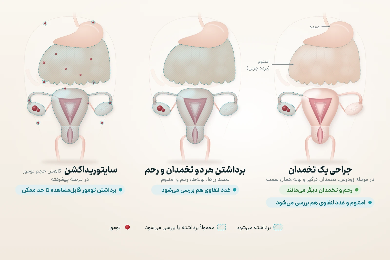 سه نمای یکسان از رحم، لوله‌ها، تخمدان‌ها و امنتوم (پرده چربی آویخته از معده): در جراحی یک تخمدان، که در مرحله زودرس و برای حفظ باروری انجام می‌شود، تخمدان درگیر و لوله همان سمت برداشته می‌شوند و رحم و تخمدان و لوله سمت دیگر می‌مانند، ولی برای مرحله‌بندی، امنتوم و غدد لنفاوی هم معمولاً برداشته یا بررسی می‌شوند؛ در برداشتن هر دو تخمدان و رحم، هر دو تخمدان، هر دو لوله، رحم و امنتوم برداشته و غدد لنفاوی بررسی می‌شوند؛ در سایتوریداکشن در مرحله پیشرفته، علاوه بر این‌ها، هر کانون قابل‌مشاهده تومور روی امنتوم و صفاق تا حد ممکن برداشته می‌شود.