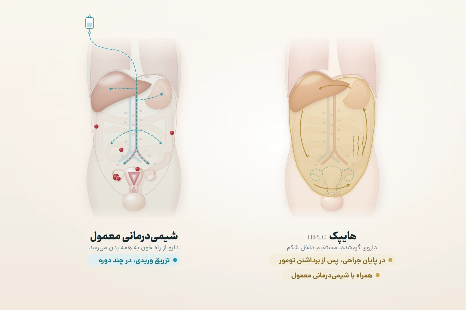 دو نمای یکسان و ساده از شکم: در هایپک (HIPEC)، که فقط برای بعضی بیماران منتخب انجام می‌شود، در پایان جراحی و پس از برداشتن تومورهای قابل‌مشاهده، داروی شیمی‌درمانی گرم‌شده مستقیم داخل حفره شکم و اطراف اندام‌ها به گردش درمی‌آید؛ در شیمی‌درمانی معمول دارو با تزریق وریدی وارد خون می‌شود و از راه رگ‌ها به همه بدن می‌رسد. هایپک جایگزین شیمی‌درمانی معمول نیست و همراه با آن انجام می‌شود.