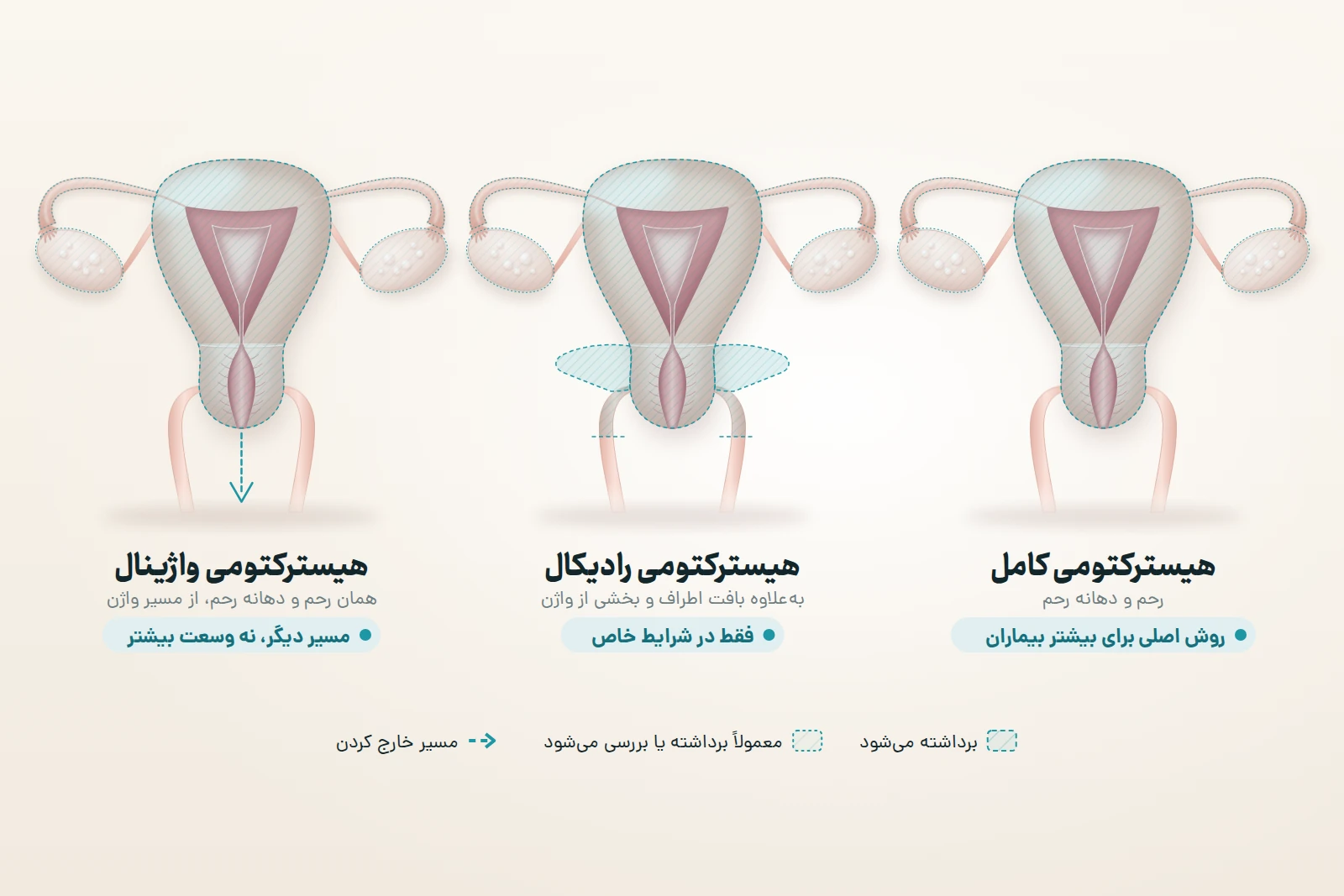 سه نمای یکسان از رحم: در هیسترکتومی کامل، که روش اصلی برای بیشتر بیماران است، رحم و دهانه رحم برداشته می‌شوند؛ در هیسترکتومی رادیکال، که فقط در شرایط خاص انجام می‌شود، بافت اطراف دهانه رحم و بخش بالایی واژن هم برداشته می‌شوند؛ در هیسترکتومی واژینال همان رحم و دهانه رحم از مسیر واژن خارج می‌شوند. لوله‌ها و تخمدان‌ها معمولاً برداشته یا بررسی می‌شوند.