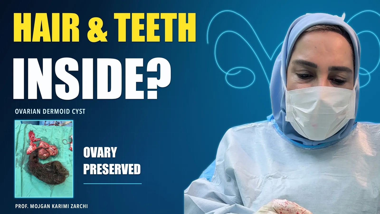 Hair and teeth inside an ovarian dermoid cyst — ovary preserved; Prof. Mojgan Karimi Zarchi