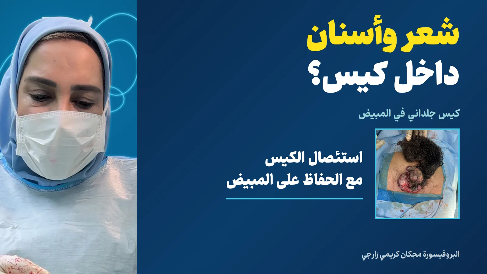 شعر وأسنان في كيس جلداني بالمبيض: استئصال الكيس مع الحفاظ على المبيض