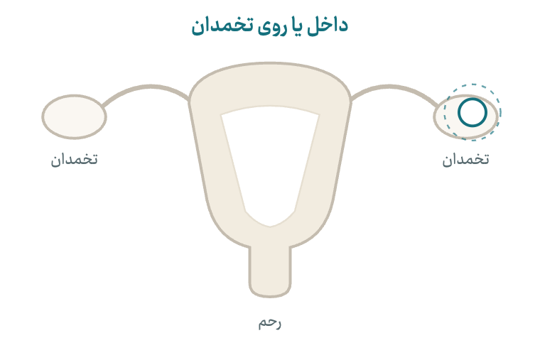 نمودار شماتیک: کیسهٔ پر از مایع داخل یا روی تخمدان