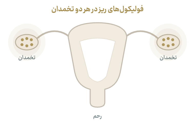 نمودار شماتیک: فولیکولهای ریز متعدد در هر دو تخمدان