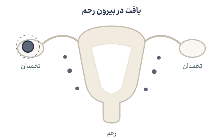 نمودار شماتیک: لکههای بافت در بیرون رحم و کیست تیره روی تخمدان