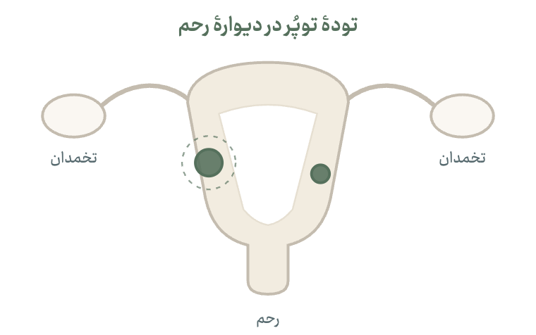 نمودار شماتیک: تودهٔ توپُر در دیوارهٔ رحم
